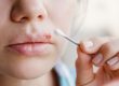 individual treating cold sores