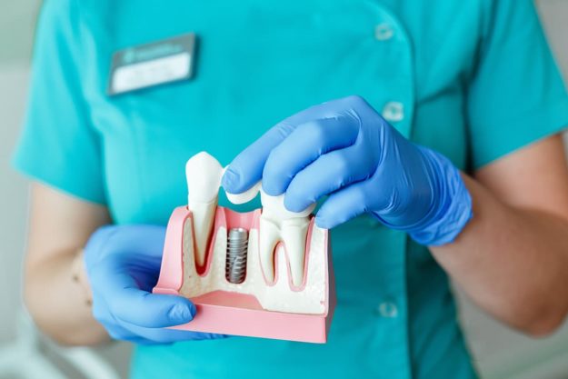 dental implants (1) dentist holding dental implants model