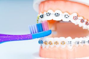 example of dental braces