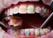 braces for kids are a great way to care for their teeth