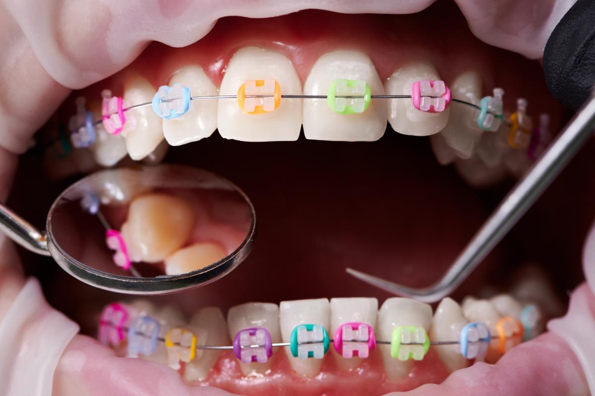 braces for kids are a great way to care for their teeth