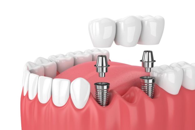 a sample symbolizes dental implants